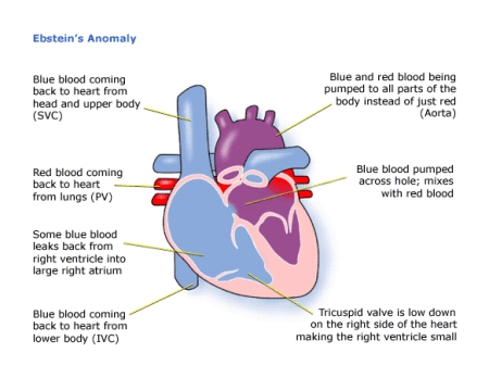 Children's Heart Federation | Ebsteins Anomaly