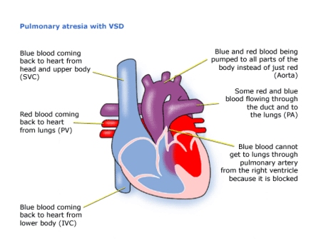Children's Heart Federation | Pulmonary Atresia